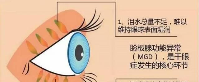 长时间看电脑眼睛疼怎么办？如何预防电脑视觉综合症？