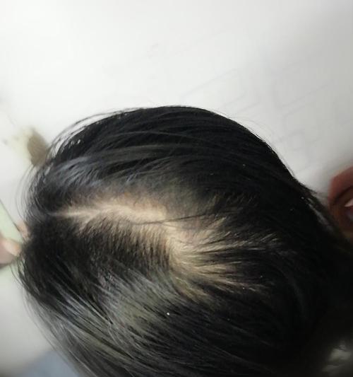 相机镜头盖出现白点是什么原因？